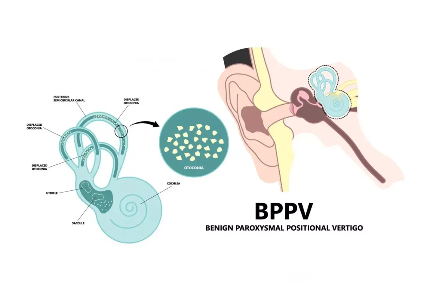 (BPPV) Benign Paroksizmal Pozisyonel Vertigo (İç Kulak Kristal Dökülmeleri)