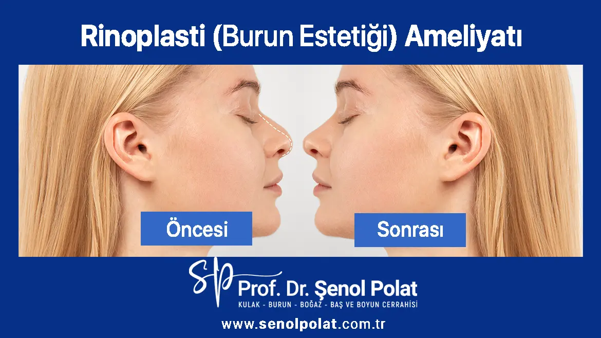 Rinoplasti - Burun Estetiği Ameliyatı