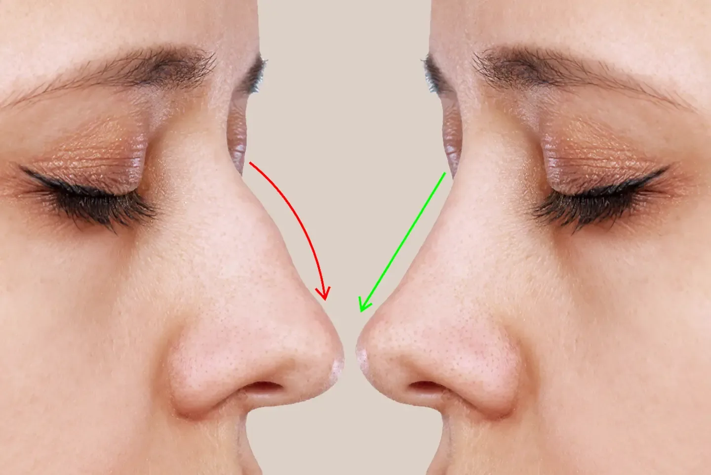 Burun Estetiği (Rinoplasti) Nedir? Nasıl Yapılır?