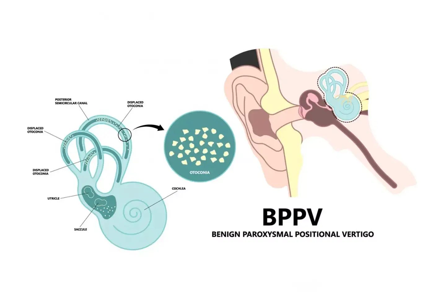 BPPV - Vertigo